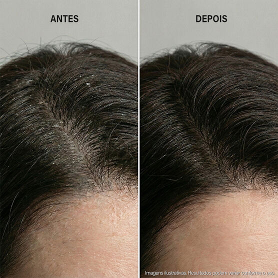 DANDRUFF DETOX DANDRUFF DETOX SHAMPOO